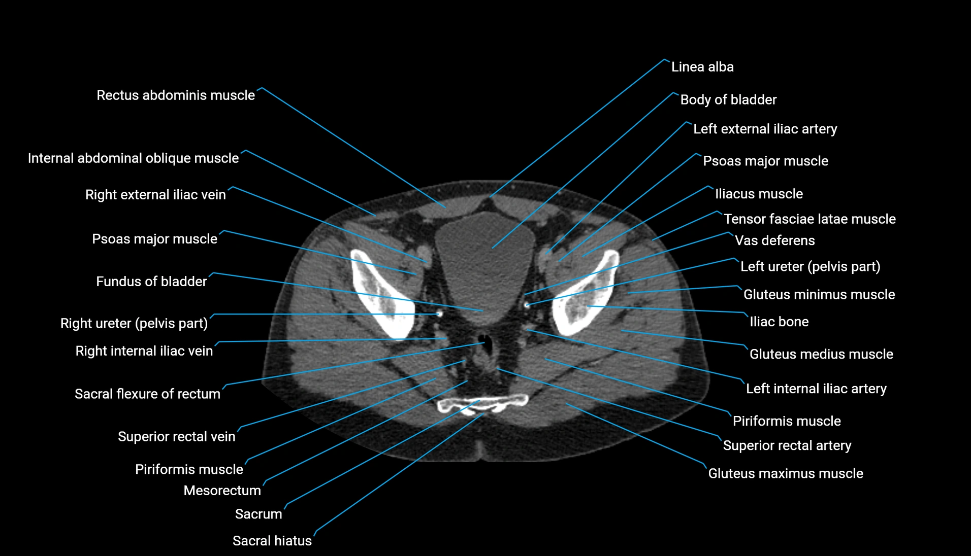CT urogram axial cross sectional anatomy  labelled radiology image-00210.webp